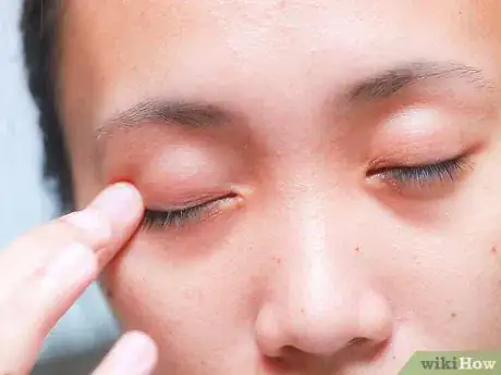 Image titled Flip Eyelids Inside Out Step 5