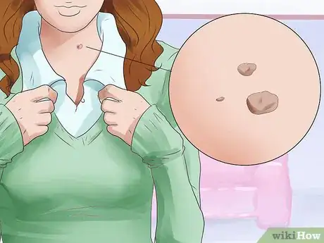 Image titled Get Rid of Skin Tags Step 5
