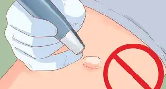 Stop a Keloid from Growing