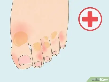 Image titled Treat Trench Foot Step 3