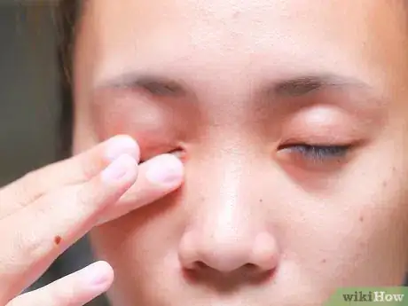 Image titled Flip Eyelids Inside Out Step 11