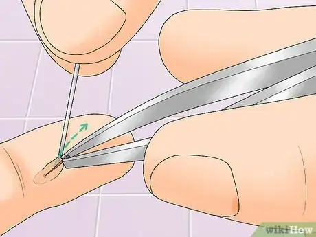 Image titled Remove Splinters in Children Step 14