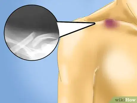 Image titled Treat a Clavicle Fracture Step 1