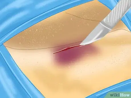 Image titled Treat a Clavicle Fracture Step 2
