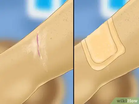Image titled Heal a Cut Due to Dry Skin Step 4