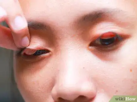 Image titled Flip Eyelids Inside Out Step 10