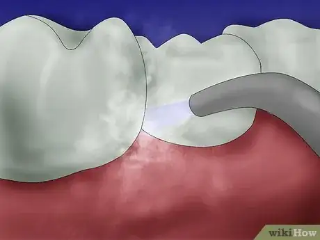 Image titled Get Rid of Gingivitis Step 6