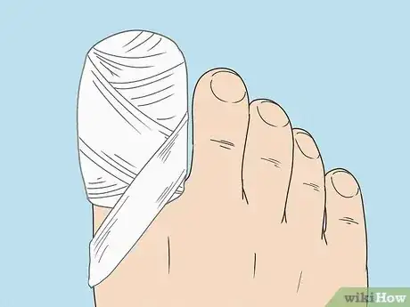 Image titled Treat a Torn Toenail Step 5