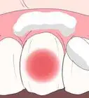 Stop Toothache Pain Fast