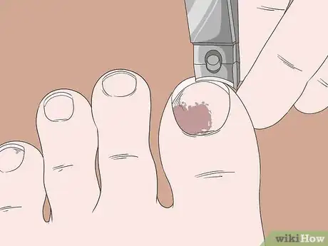 Image titled Heal a Bruised Toe Step 10