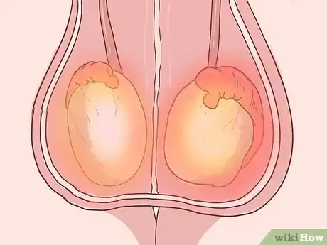 Image titled Treat Pain and Swelling in the Testicles Step 10