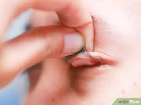 Image titled Flip Eyelids Inside Out Step 3