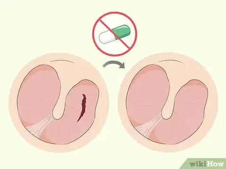 Image titled Heal a Ruptured Eardrum Step 5