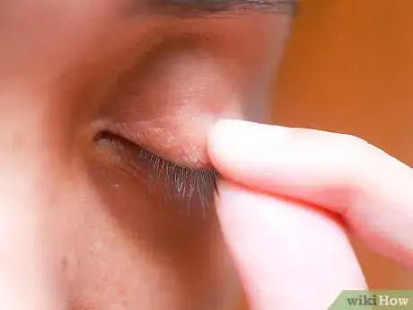 Image titled Flip Eyelids Inside Out Step 1