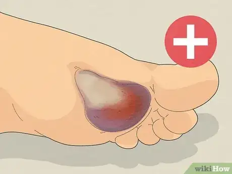 Image titled Treat a Blood Blister Step 7