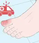 Heal a Bruised Toe