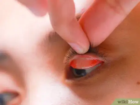Image titled Flip Eyelids Inside Out Step 9