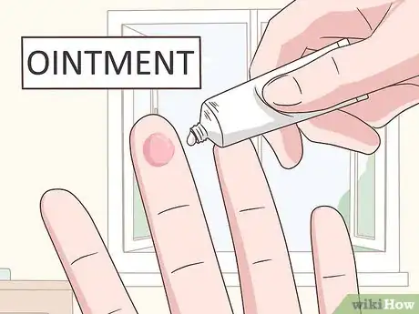 Imagen titulada Treat a Blistering Burn on Your Finger Step 8