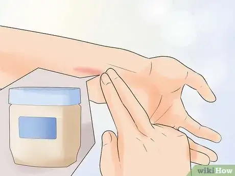 Imagen titulada Treat a Small Burn Step 17