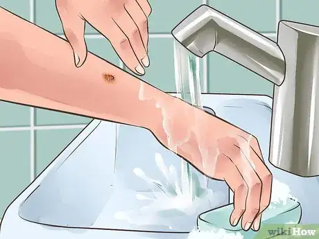 Imagen titulada Heal from a Skin Biopsy Step 6