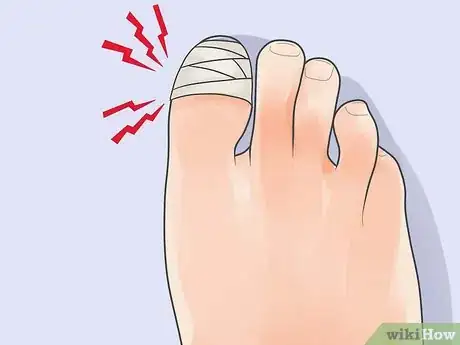 Imagen titulada Treat a Stubbed Toe Step 9
