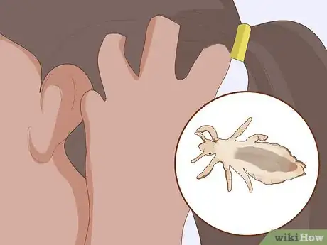 Imagen titulada Prevent Lice Step 1