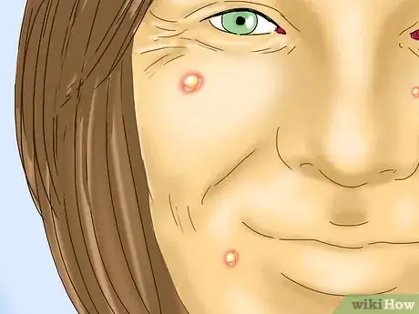 Imagen titulada Prepare for a Microdermabrasion Step 15