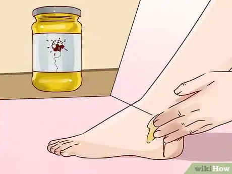 Imagen titulada Get Rid of Ringworm Scars Step 5