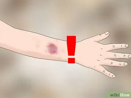 Imagen titulada Identify Bed Bug Bites Step 4