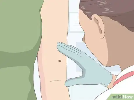 Imagen titulada Remove Moles Quickly Step 1