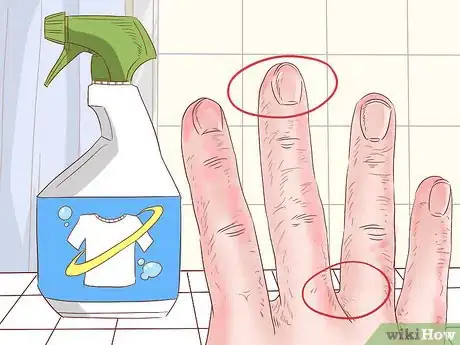 Imagen titulada Treat Hand Eczema Step 2