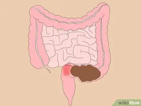 Imagen titulada Know If You Have Worms Step 2