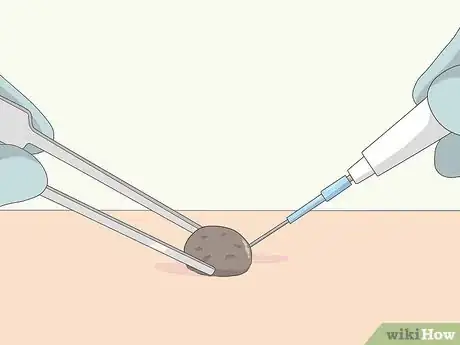 Imagen titulada Remove Moles Quickly Step 6