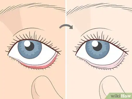 Imagen titulada Know If You Have Worms Step 8