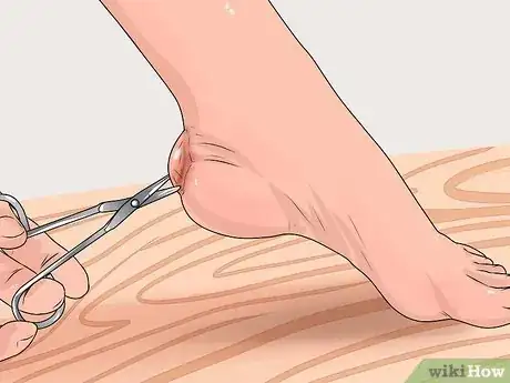 Imagen titulada Care for a Burst Blister Step 10