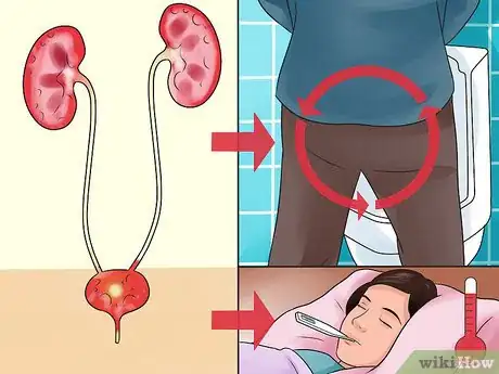Imagen titulada Get Rid of a UTI Fast Step 2