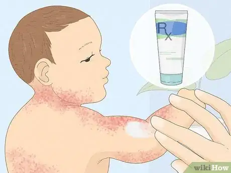 Imagen titulada Treat Baby Heat Rash Step 11