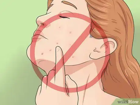 Imagen titulada Heal Acne Fast and Naturally Step 3