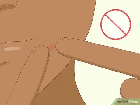 Imagen titulada Avoid Blind Pimples Step 5
