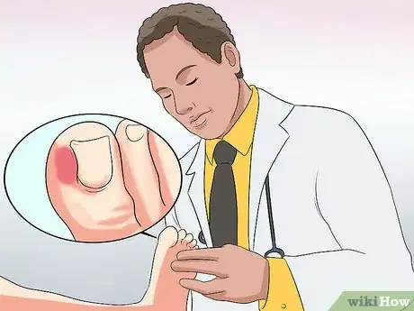 Imagen titulada Heal an Ingrown Toenail Step 11