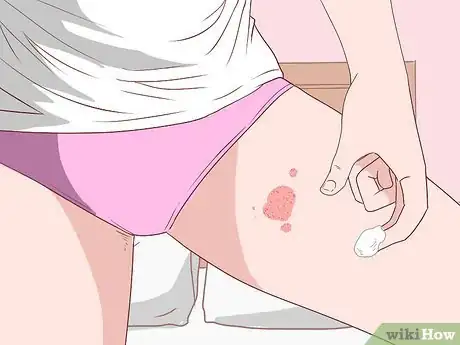 Imagen titulada Treat Jock Itch With Sudocrem Step 10