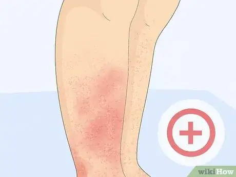 Imagen titulada Treat a Face Rash After Waxing Step 15