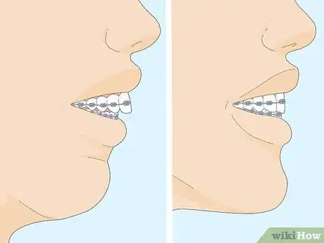 Imagen titulada Fix an Overbite Step 8