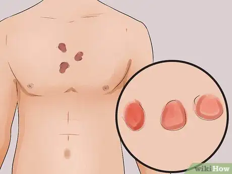 Imagen titulada Tell the Difference Between Eczema and Psoriasis Step 1