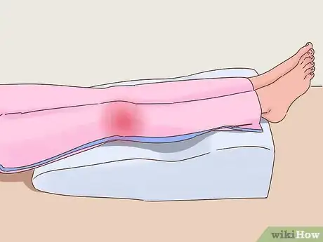 Imagen titulada Get Rid of Bruises Step 2