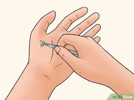 Imagen titulada Remove a Pin or Tack from Your Skin Step 4