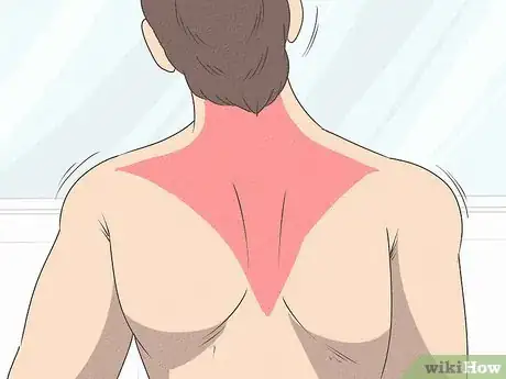Imagen titulada Heal a Pulled Trapezius Muscle Step 1
