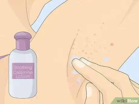 Imagen titulada Treat a Face Rash After Waxing Step 14