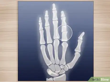 Imagen titulada Splint a Finger Step 8
