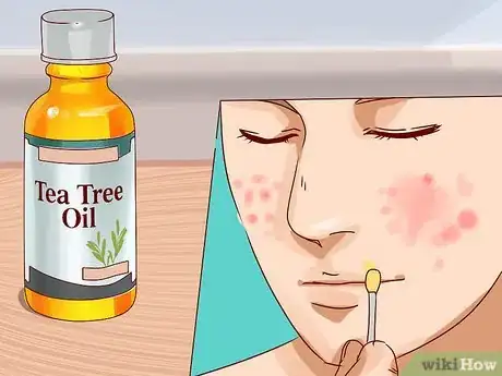 Imagen titulada Get Rid of a Deep Pimple Step 13